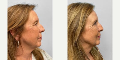 Eyelid Surgery before and after photo
