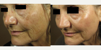 Fraxel Laser before and after photo