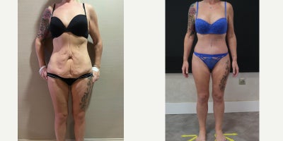 Mommy Makeover before and after photo