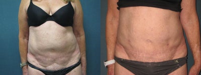 Smart Lipo before and after photo