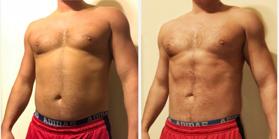 Emsculpt before and after photo