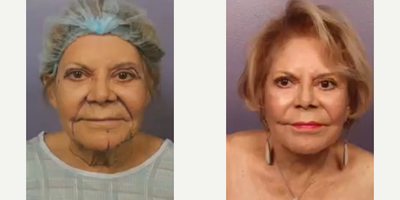 Facelift before and after photo