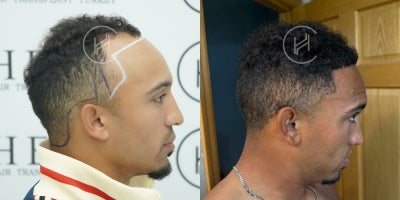 Hair Transplant before and after photo