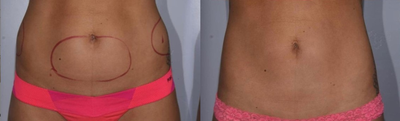 CoolSculpting before and after photo