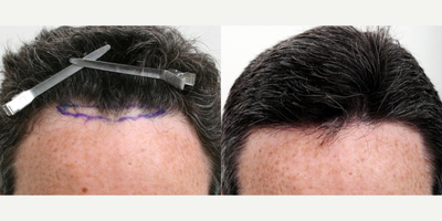 FUE Hair Transplant before and after photo