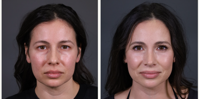 Rhinoplasty before and after photo