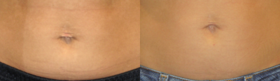 Belly Button Surgery before and after photo