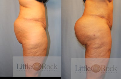 Brazilian Butt Lift before and after photo