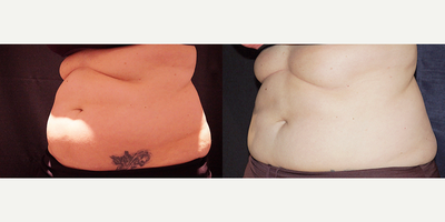 CoolSculpting before and after photo