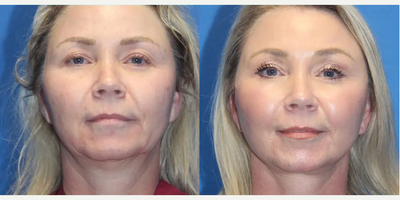 Facelift before and after photo