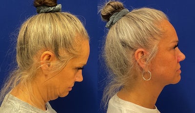 before and after image