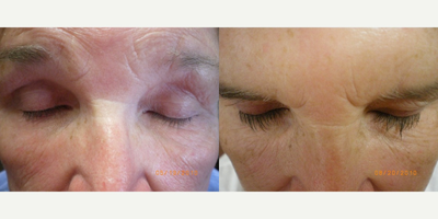 Latisse before and after photo