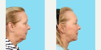 Neck Lift before and after photo