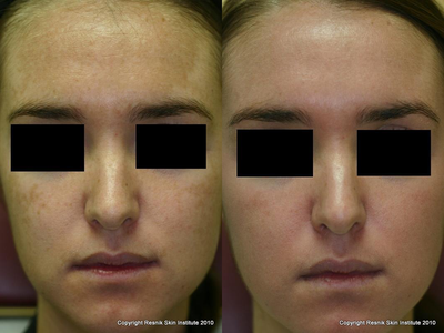 TCA Peel before and after photo