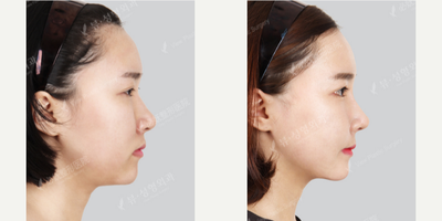 Asian Rhinoplasty before and after photo