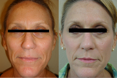CO2 Laser before and after photo