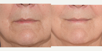 Juvederm before and after photo