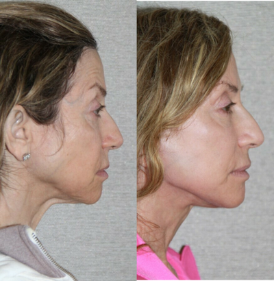 Neck Lift before and after photo