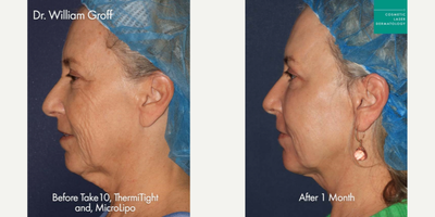 ThermiTight before and after photo