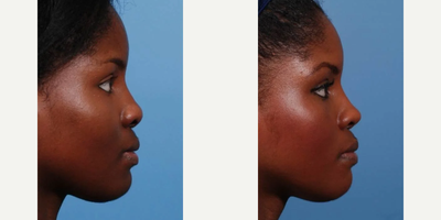 African American Rhinoplasty before and after photo