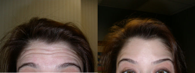 Botox before and after photo