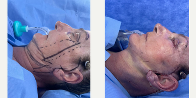 Facelift before and after photo