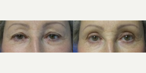 Eyelid Surgery before and after photo