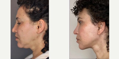 Facelift before and after photo