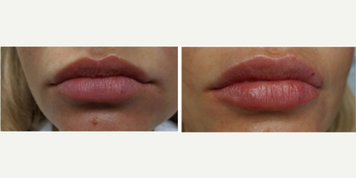 Lip Fillers before and after photo