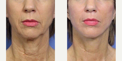 Mini Facelift before and after photo