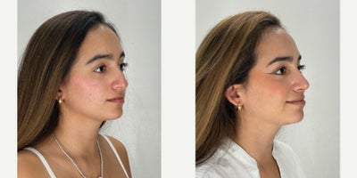 Rhinoplasty before and after photo