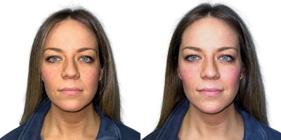 Dermal Fillers before and after photo