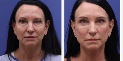 Double Eyelid Surgery before and after photo
