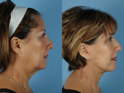 Facelift before and after photo