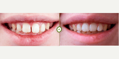 Invisalign before and after photo
