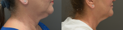 Kybella before and after photo