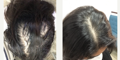 PRP for Hair Loss before and after photo