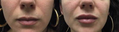 Restylane before and after photo