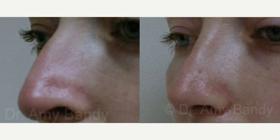 Rhinoplasty before and after photo