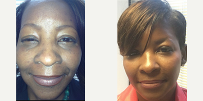 Voluma before and after photo