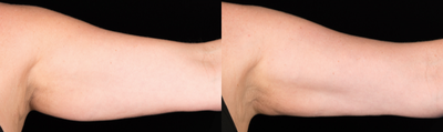 CoolSculpting before and after photo