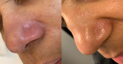 HydraFacial before and after photo