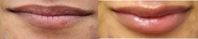 Juvederm before and after photo