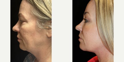 Neck Lift before and after photo