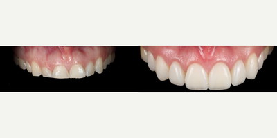 Porcelain Veneers before and after photo