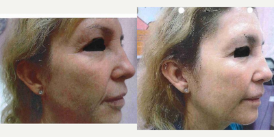 Skin Rejuvenation before and after photo