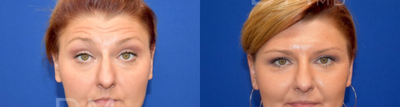 Botox before and after photo