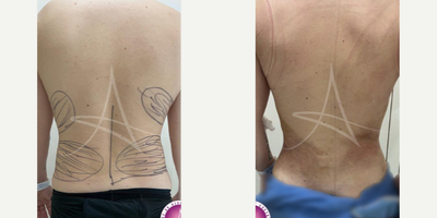 Lipo 360 before and after photo