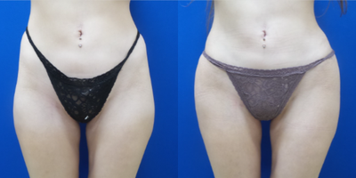 Butt Implants before and after photo