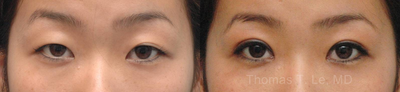 Double Eyelid Surgery before and after photo